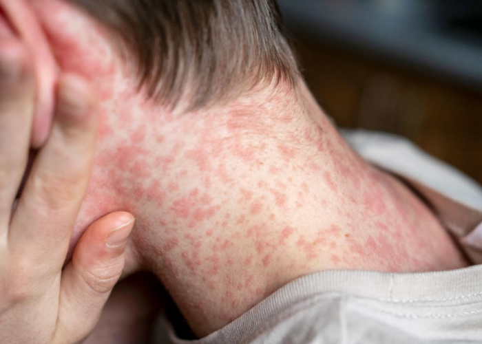 Dokter Spesialis Anak Warning Waspada Campak, Upaya Melindungi Anak dan Keluarga